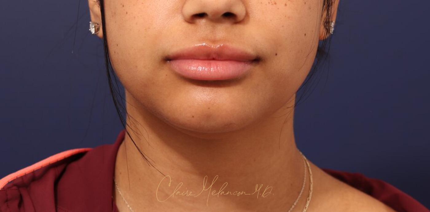 Neck Liposuction Before & After Photo