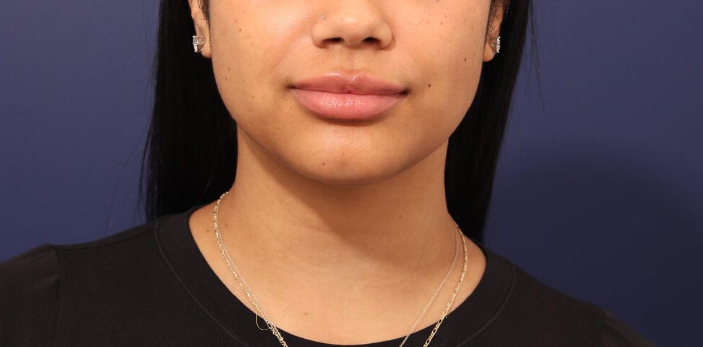 Neck Liposuction Before & After Photo