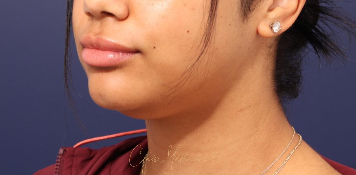 Neck Liposuction Before & After Photo