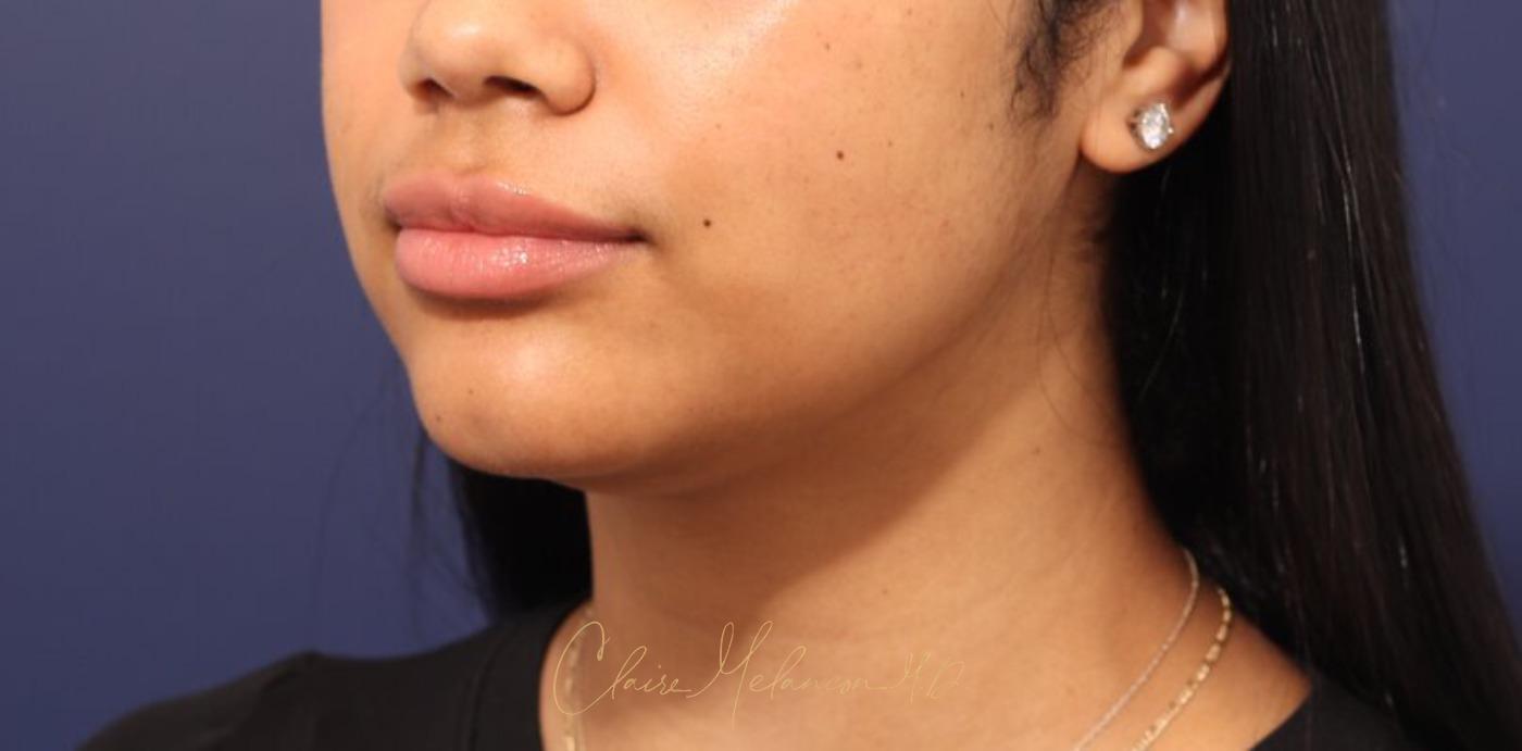Neck Liposuction Before & After Photo