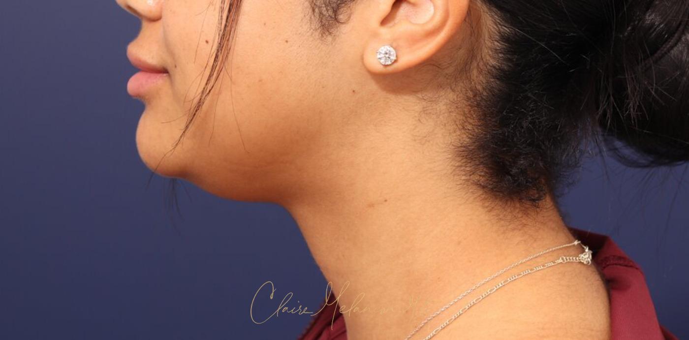 Neck Liposuction Before & After Photo