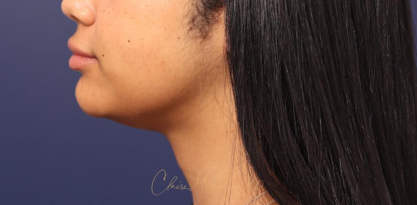 Neck Liposuction Before & After Photo