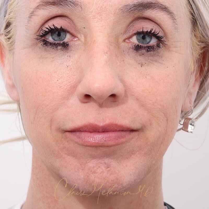 Rhinoplasty and Chin Augmentation Before & After Photo