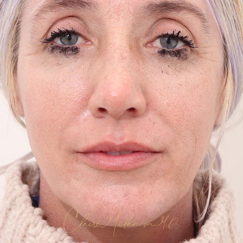 Rhinoplasty and Chin Augmentation Before & After Photo
