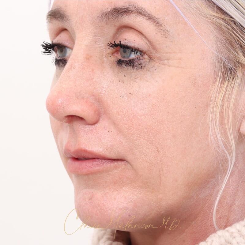 Rhinoplasty and Chin Augmentation Before & After Photo