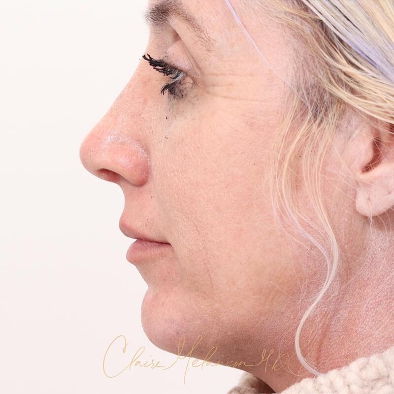 Rhinoplasty and Chin Augmentation Before & After Photo