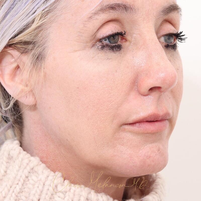 Rhinoplasty and Chin Augmentation Before & After Photo