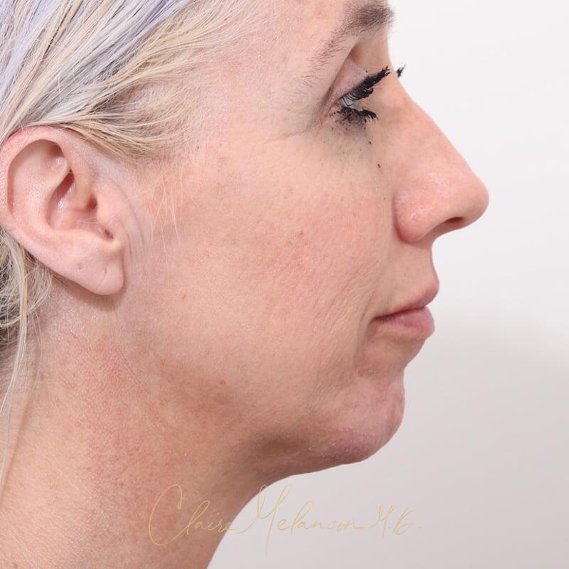 Rhinoplasty and Chin Augmentation Before & After Photo