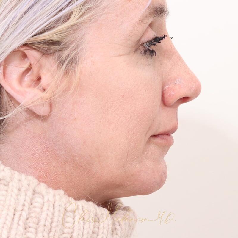 Rhinoplasty and Chin Augmentation Before & After Photo