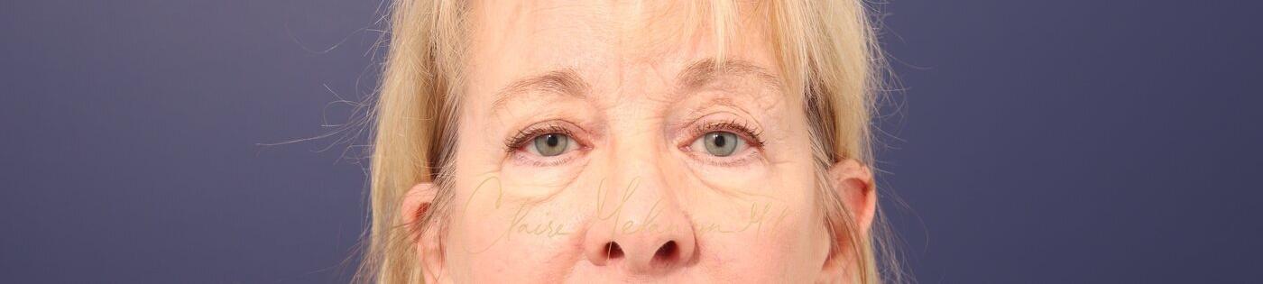 Upper Blepharoplasty Before & After Photo