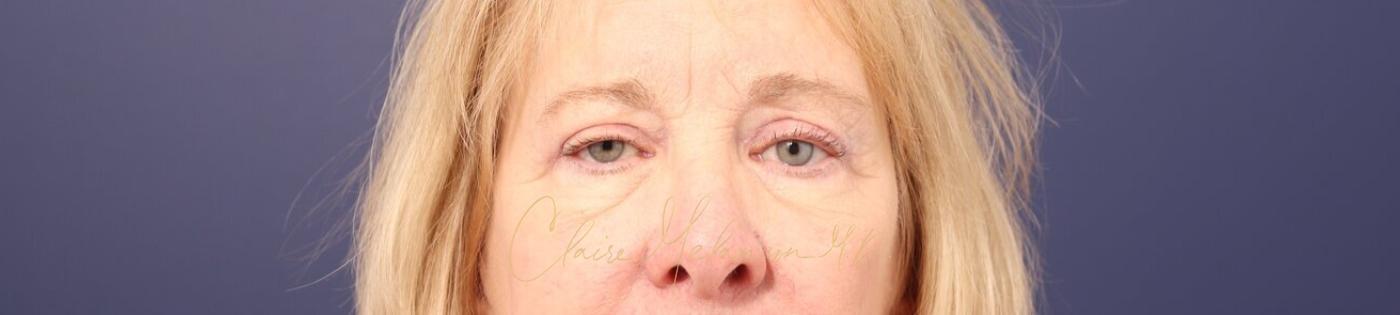 Upper Blepharoplasty Before & After Photo