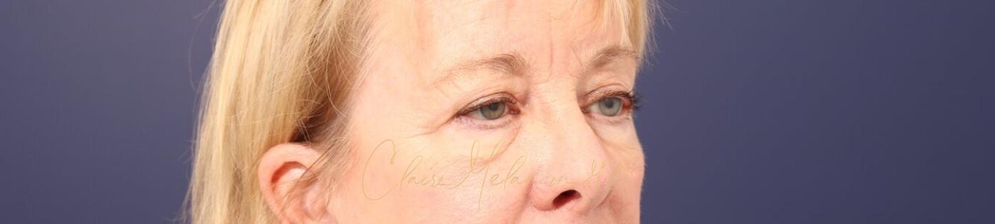 Upper Blepharoplasty Before & After Photo