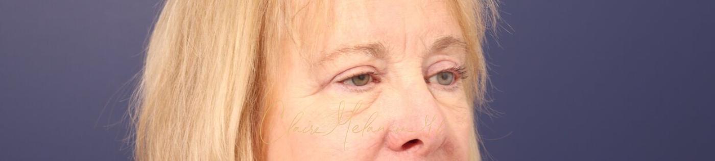 Upper Blepharoplasty Before & After Photo