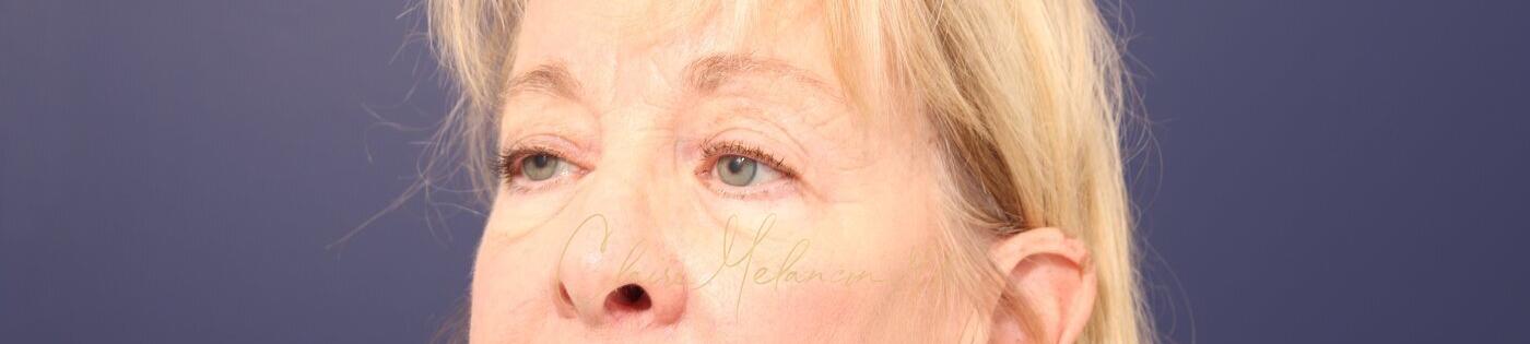 Upper Blepharoplasty Before & After Photo