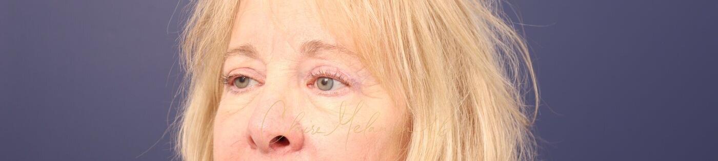 Upper Blepharoplasty Before & After Photo