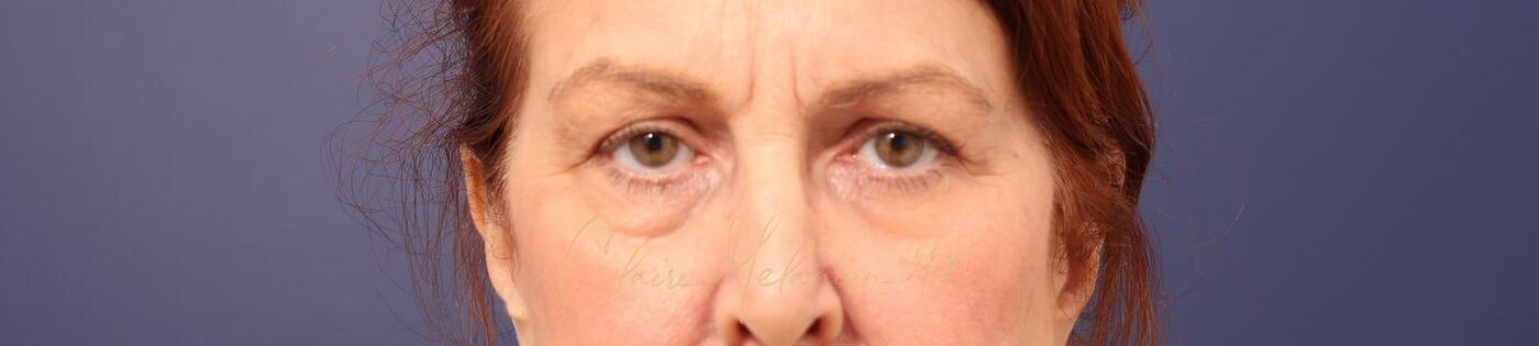 Upper Blepharoplasty Before & After Photo