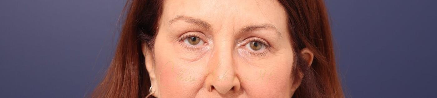 Upper Blepharoplasty Before & After Photo