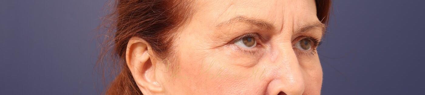 Upper Blepharoplasty Before & After Photo