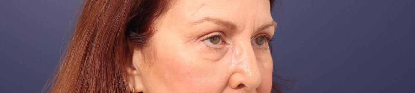 Upper Blepharoplasty Before & After Photo