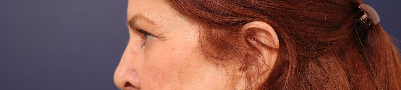 Upper Blepharoplasty Before & After Photo