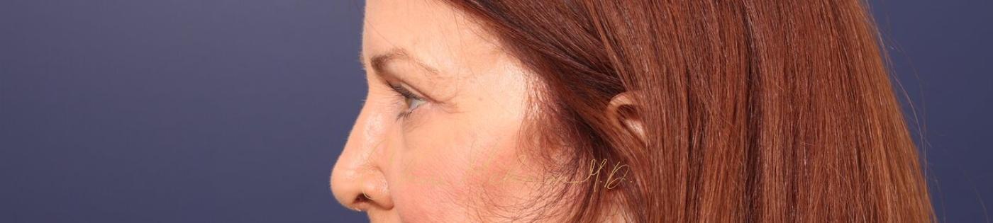 Upper Blepharoplasty Before & After Photo