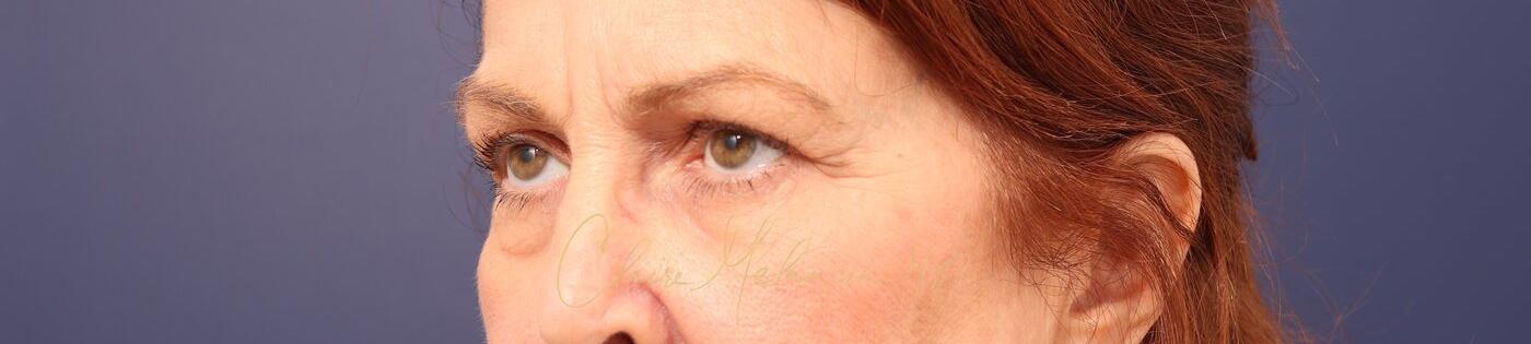 Upper Blepharoplasty Before & After Photo