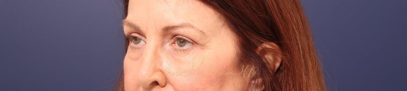 Upper Blepharoplasty Before & After Photo