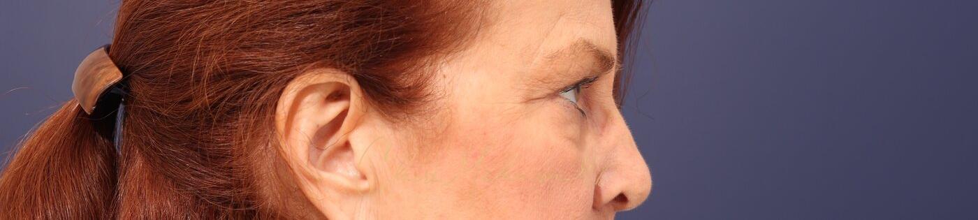 Upper Blepharoplasty Before & After Photo