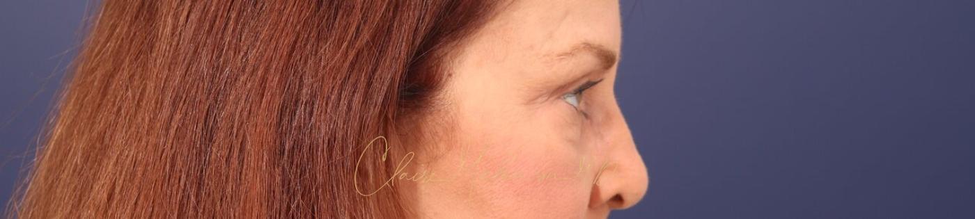 Upper Blepharoplasty Before & After Photo