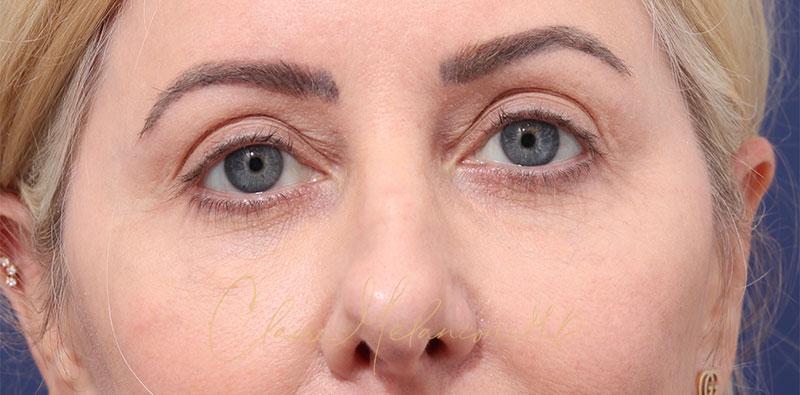 Revision Rhinoplasty Before & After Photo