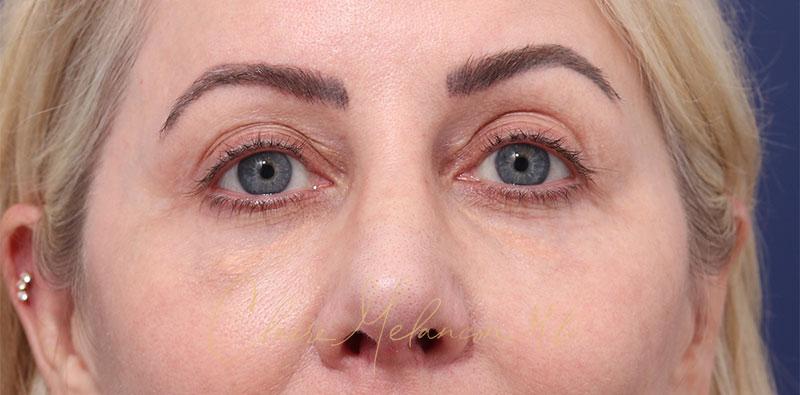 Revision Rhinoplasty Before & After Photo