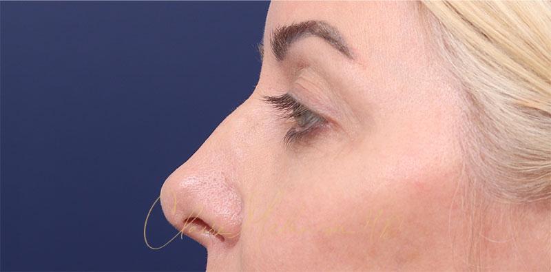 Revision Rhinoplasty Before & After Photo