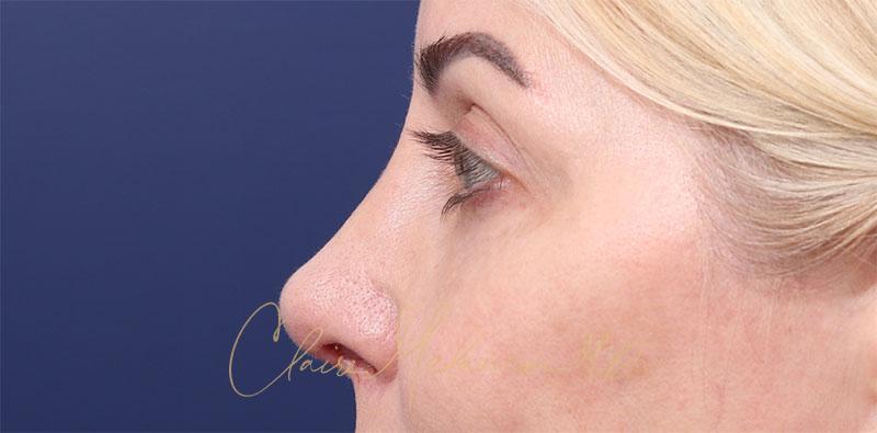 Revision Rhinoplasty Before & After Photo