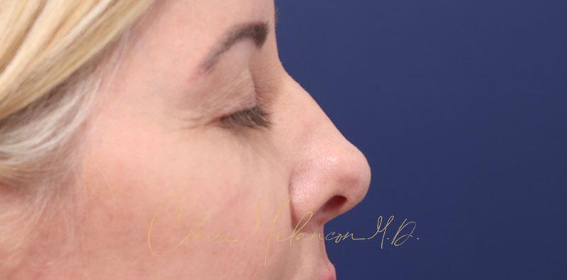 Revision Rhinoplasty Before & After Photo