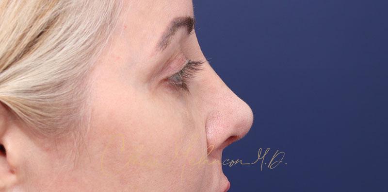 Revision Rhinoplasty Before & After Photo