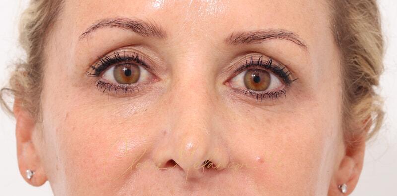 Revision Rhinoplasty Before & After Photo