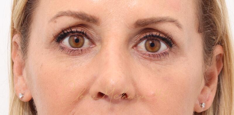 Revision Rhinoplasty Before & After Photo