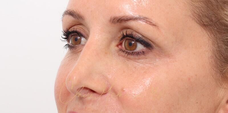 Revision Rhinoplasty Before & After Photo