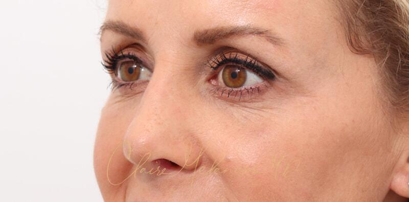 Revision Rhinoplasty Before & After Photo