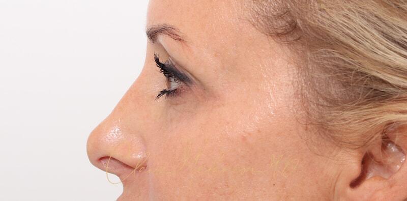 Revision Rhinoplasty Before & After Photo