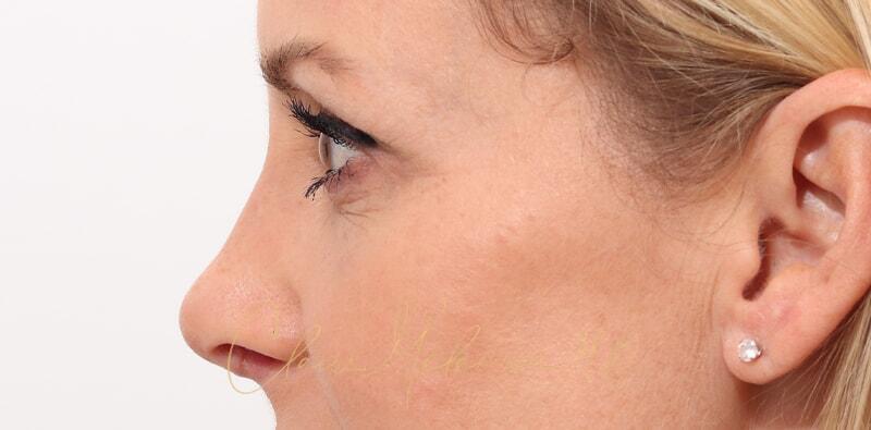 Revision Rhinoplasty Before & After Photo