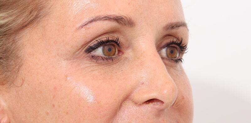 Revision Rhinoplasty Before & After Photo