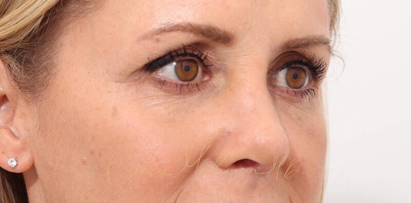 Revision Rhinoplasty Before & After Photo