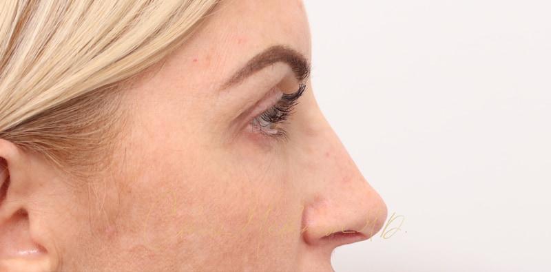 Revision Rhinoplasty Before & After Photo