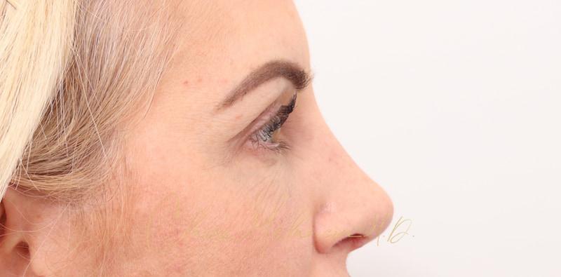 Revision Rhinoplasty Before & After Photo