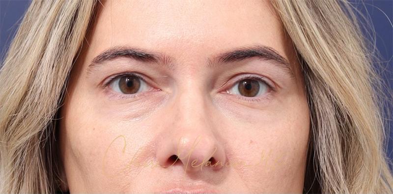 Rhinoplasty Before & After Photo