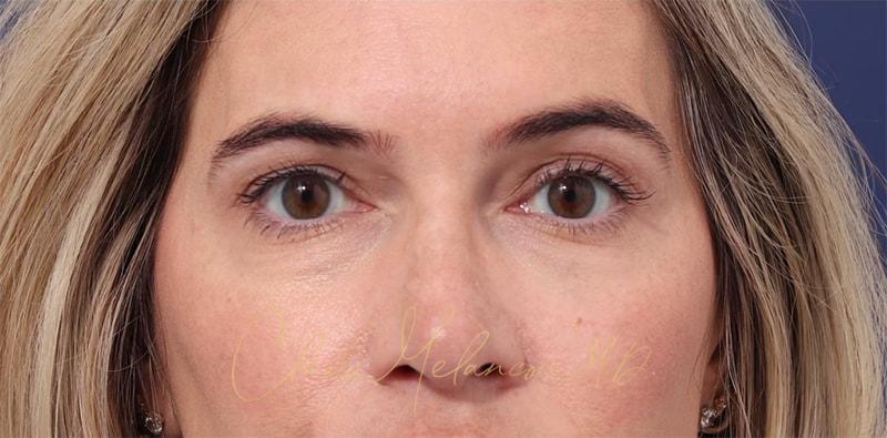 Rhinoplasty Before & After Photo