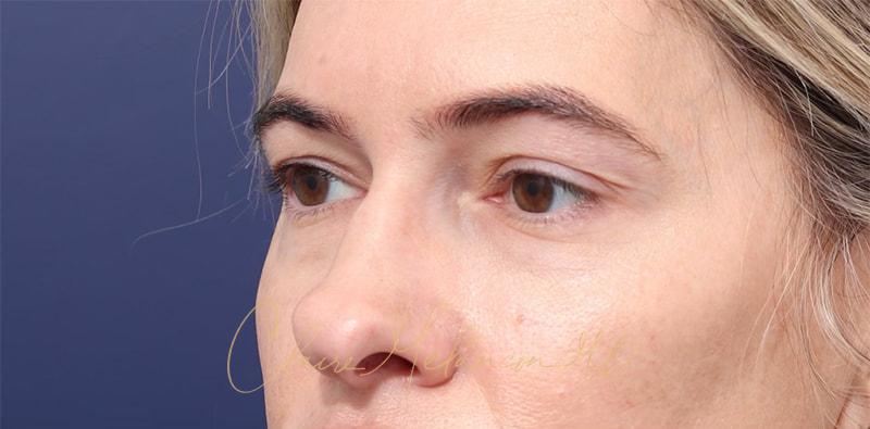 Rhinoplasty Before & After Photo