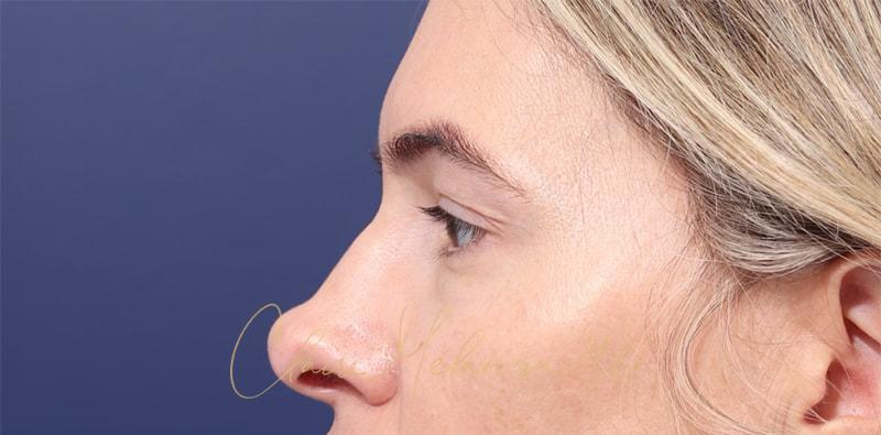 Rhinoplasty Before & After Photo
