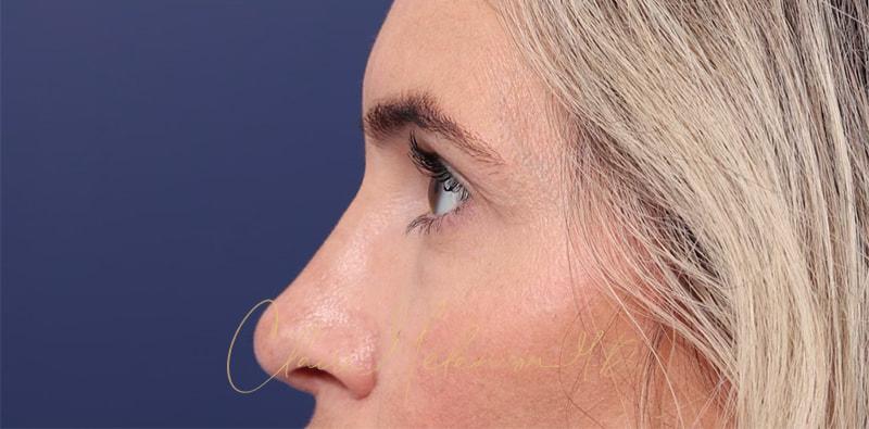 Rhinoplasty Before & After Photo